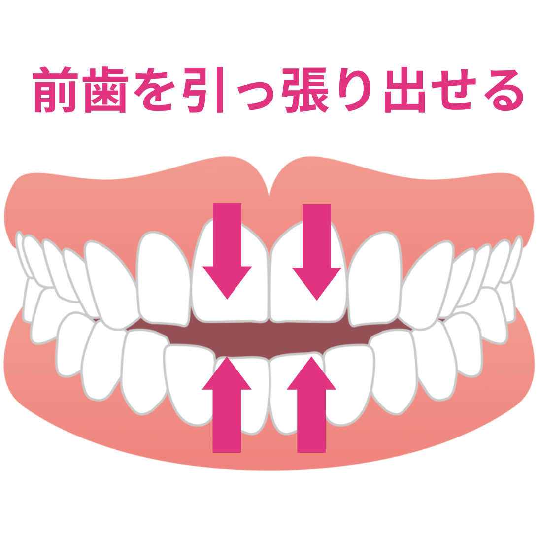 インビザラインで前歯を挺出する様子を説明したイラスト