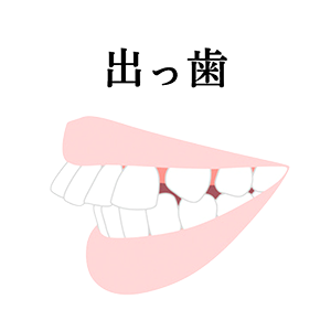 出っ歯治療について解説したページへのリンク