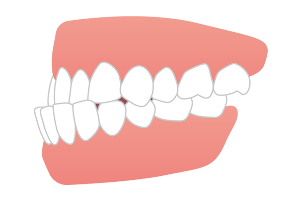 下の歯が上の歯より前に出ている受け口（反対咬合・下顎前突）