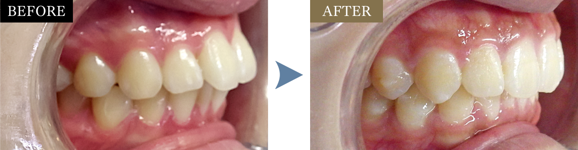 出っ歯と口ゴボの状態から美しい歯並びに改善したビフォーアフター症例写真