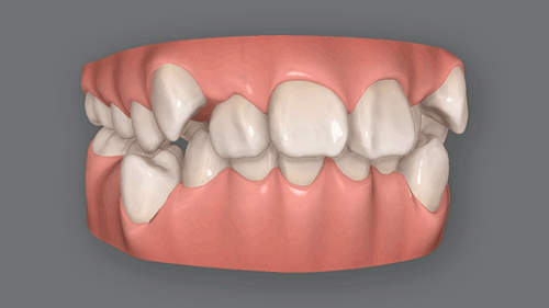 精密な歯の移動シミュレーションのイメージ画像