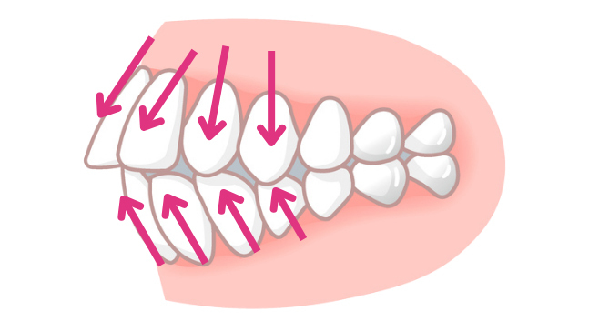 ＡＩの言うまま非抜歯矯正