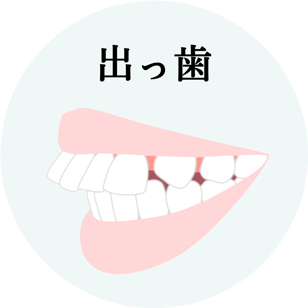 出っ歯とはどんな状態かを表すイラスト