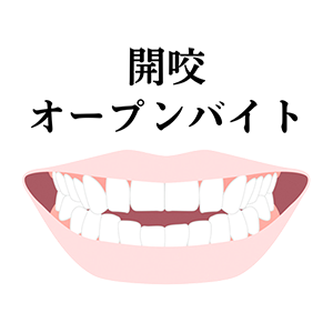 開咬の治療について解説したページへのリンク