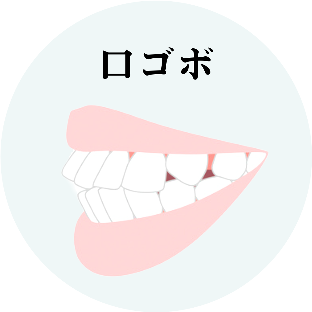 口ゴボの状態を表すイラスト