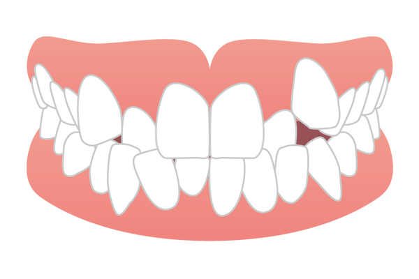 歯がデコボコに重なり合っている叢生（ガチャ歯）