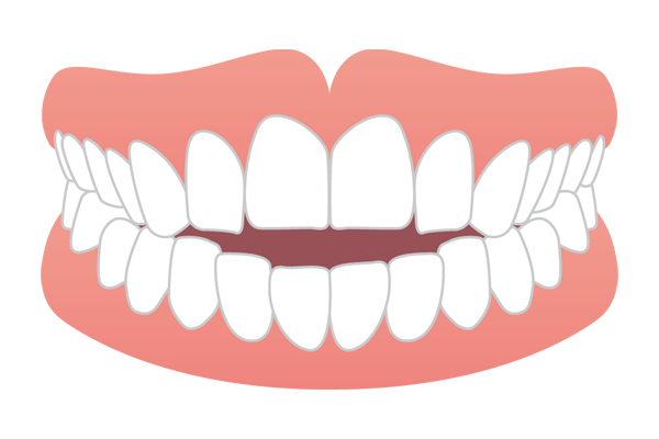奥歯を噛んでも前歯が閉じない開咬（オープンバイト）
