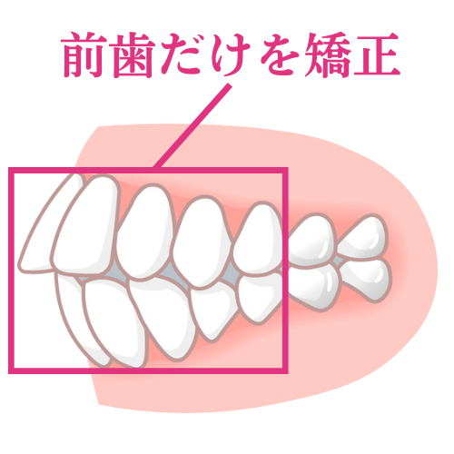 前歯だけの矯正を無理に実行