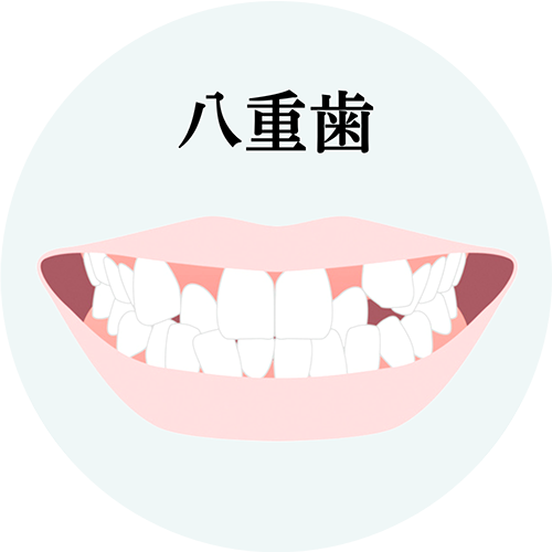 八重歯治療について解説したページへのリンク