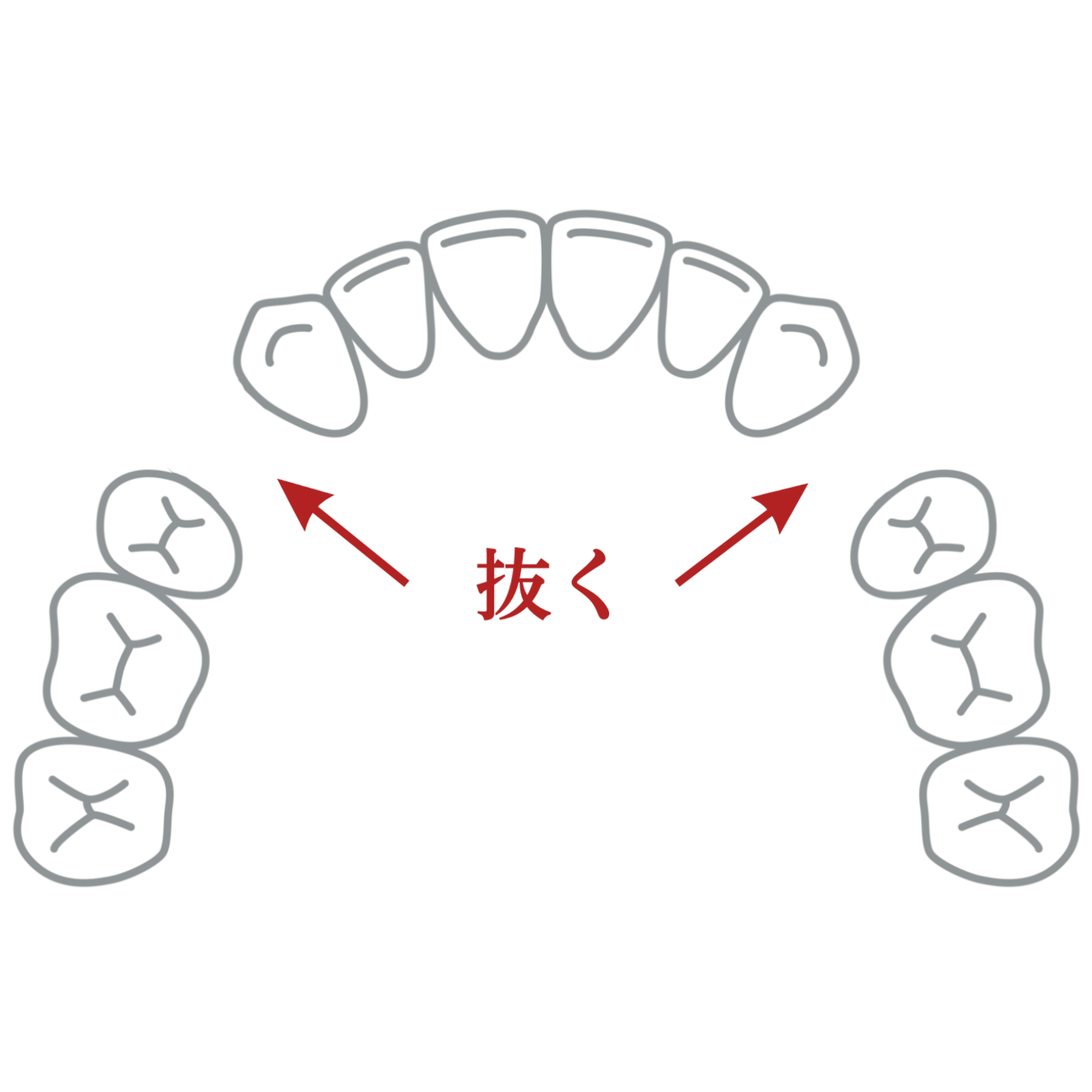 前から4番目の歯を抜いたあとの歯並びのイラスト
