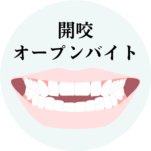 開咬の治療について解説したページへのリンク