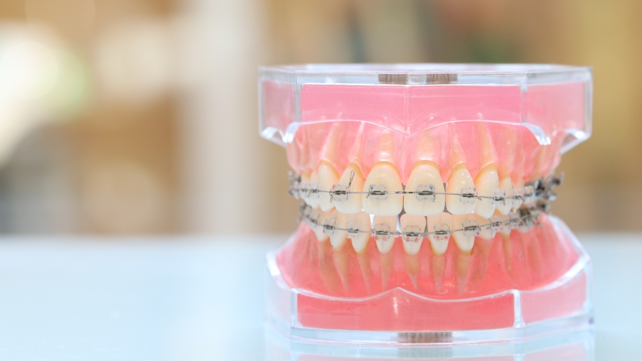 表側にブラケットを装着したワイヤー矯正