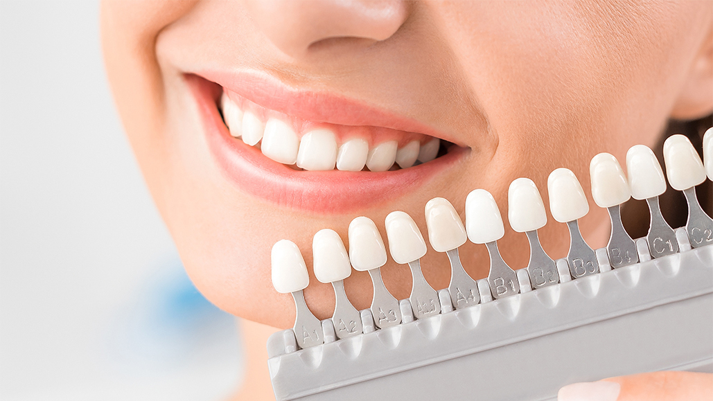 矯正治療と並行してホワイトニングを行い白い歯を手に入れた患者