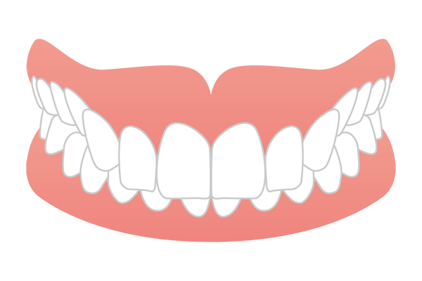 上の前歯が下の歯を深く覆い隠す過蓋咬合（ディープバイト）