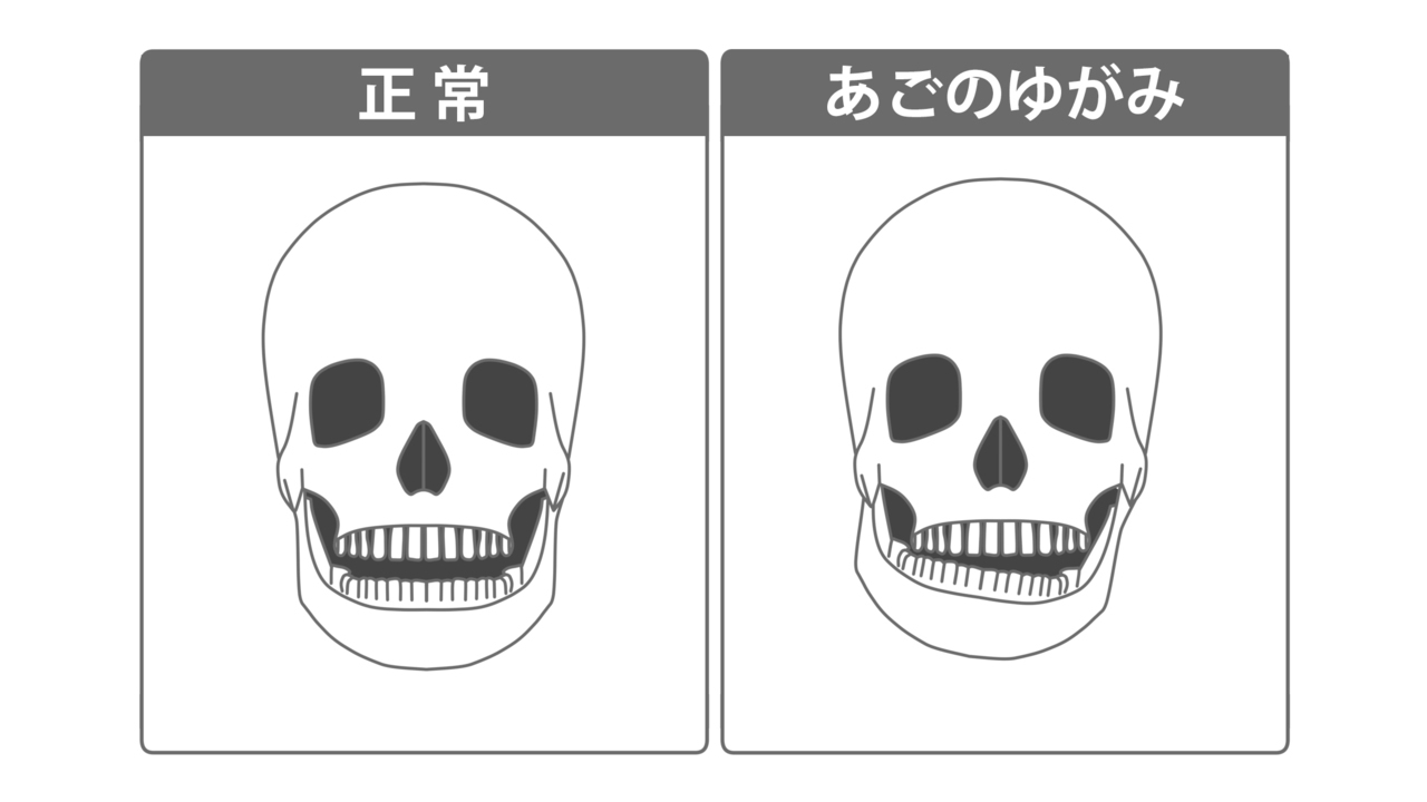 噛み合わせが悪いとあごが歪み始める