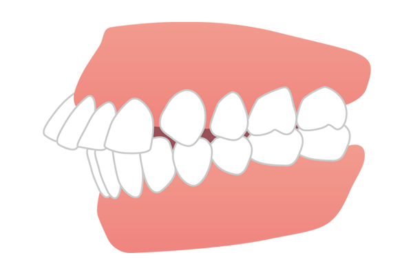 上の前歯が前方に出ている出っ歯（上顎前突）