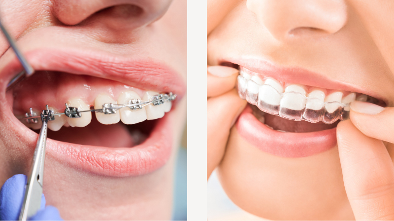 ワイヤー矯正装置とマウスピース矯正装置の画像