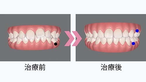 治療前後の比較ができるシミュレーションについて解説したページへのリンク