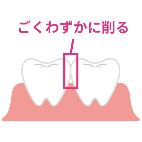 歯を削って矯正するIPRのイラスト