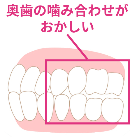 奥歯が噛み合っていない歯列のイラスト