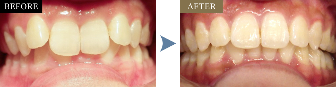 歯のデコボコと深い噛み合わせが改善されたビフォーアフター症例写真
