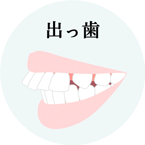 出っ歯治療について解説したページへのリンク