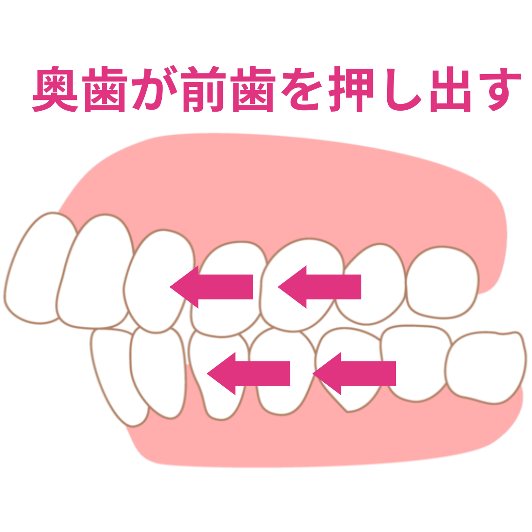 奥歯が前歯を押している歯並びのイラスト