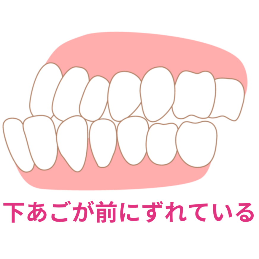 下の前歯とあごが引っ込んでいるイラスト