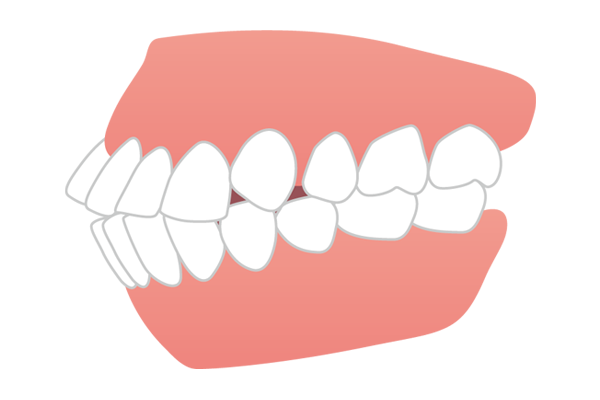 上下の前歯が前方に突出した口ゴボ（上下顎前突）
