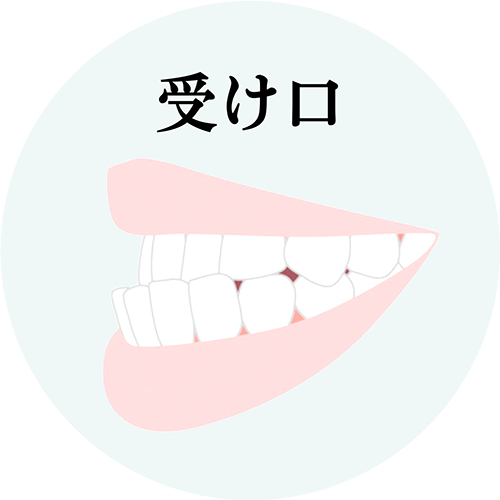 受け口治療について解説したページへのリンク