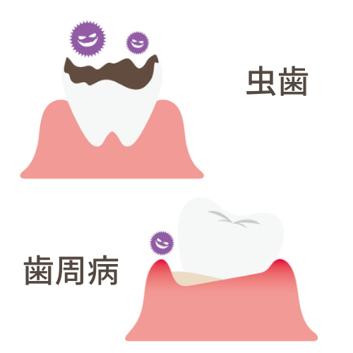 虫歯や歯周病のイラスト