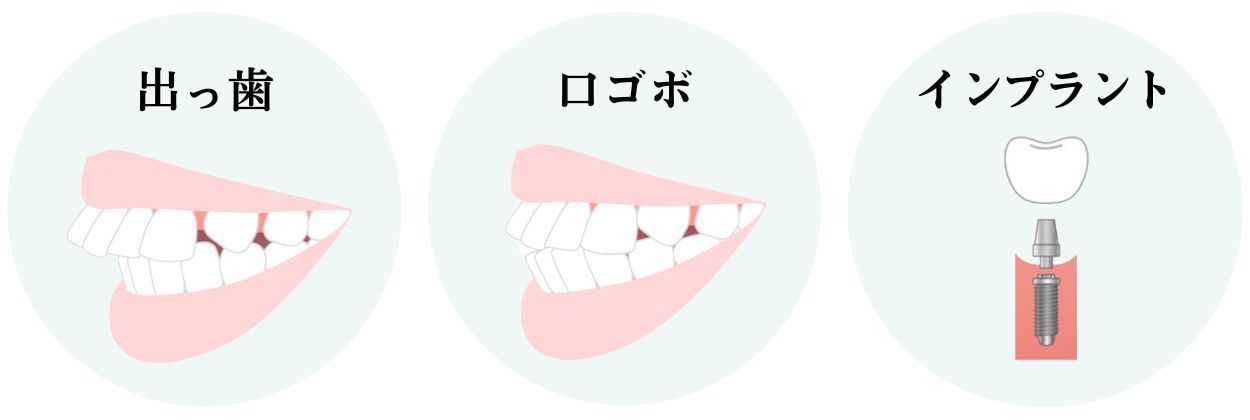 出っ歯・口ゴボ・インプラントのイラスト