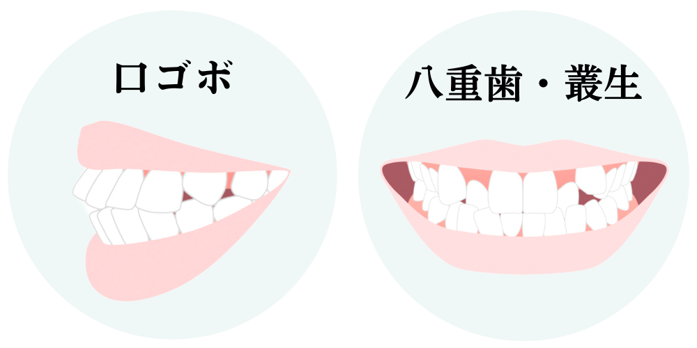 口ボコと八重歯・叢生の歯並びのイラスト