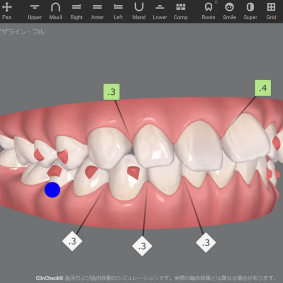 3D画像を使って治療計画を説明する様子