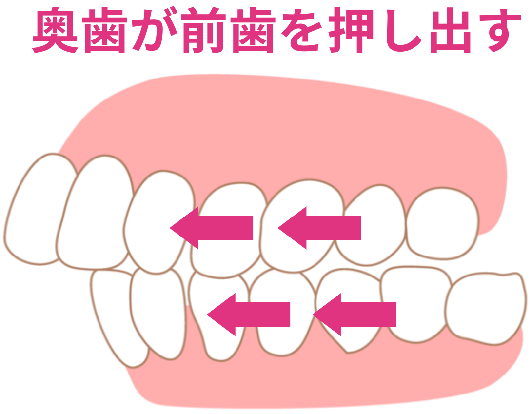 奥歯が前歯を押し出して口ゴボを引き起こすイメージ