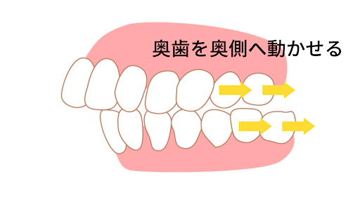 奥歯を動かせば 前歯がキレイに並ぶ