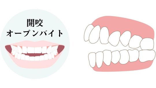 開咬(オープンバイト)の原因・矯正法を解説|吉祥寺壱番館歯科